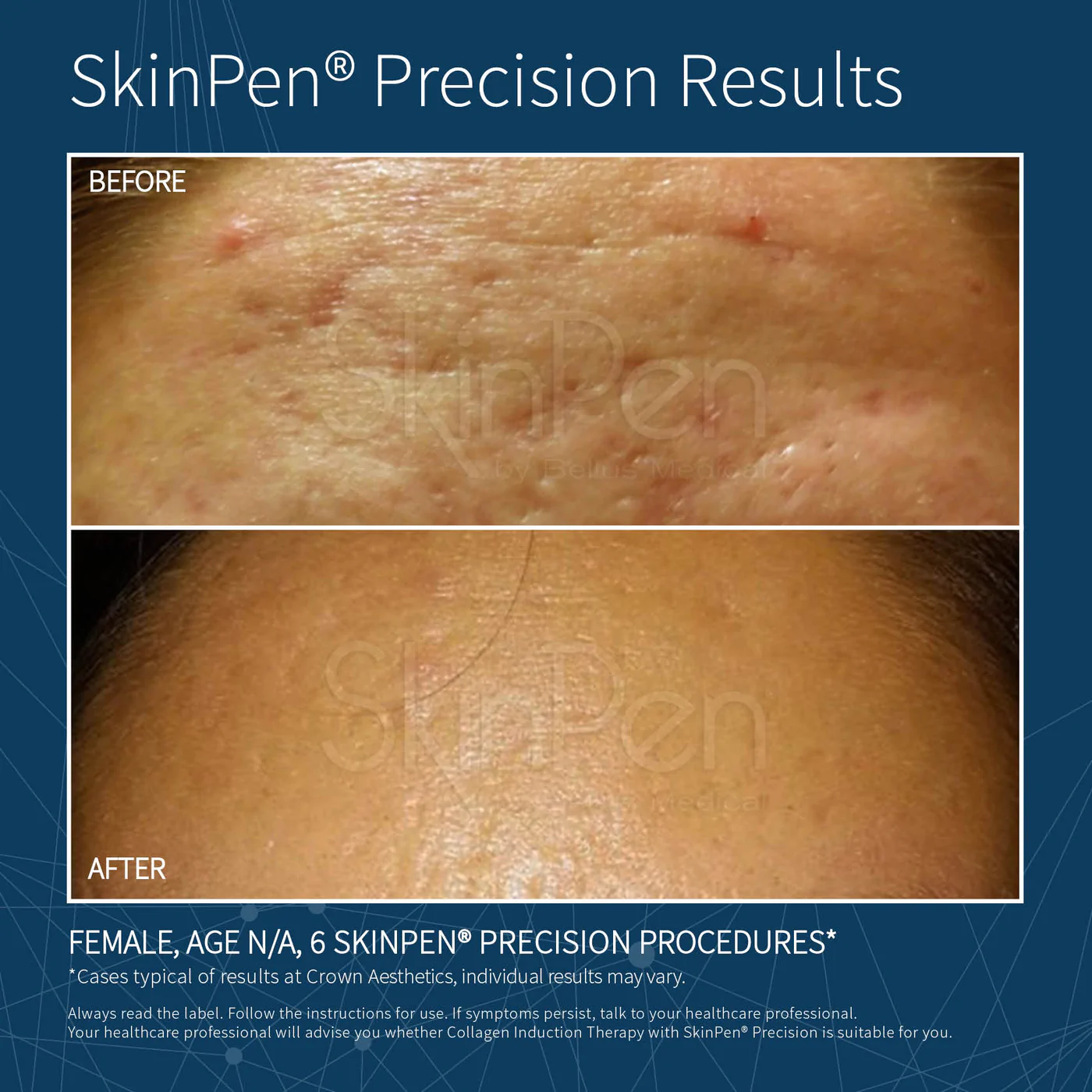 Skinpen before after 2